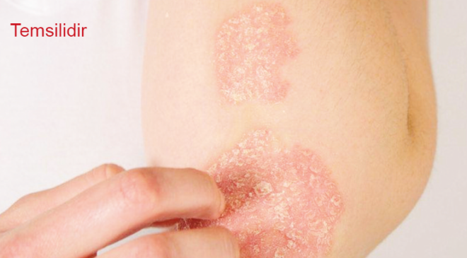 Sedef kontrol edilebilir bir hastalık