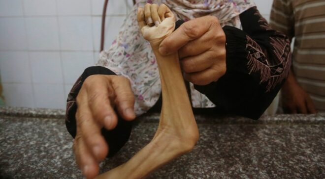 Can kaybının 59 bini aştığı Gazze’de son 24 saatte 19 kişi açlıktan hayatını kaybetti