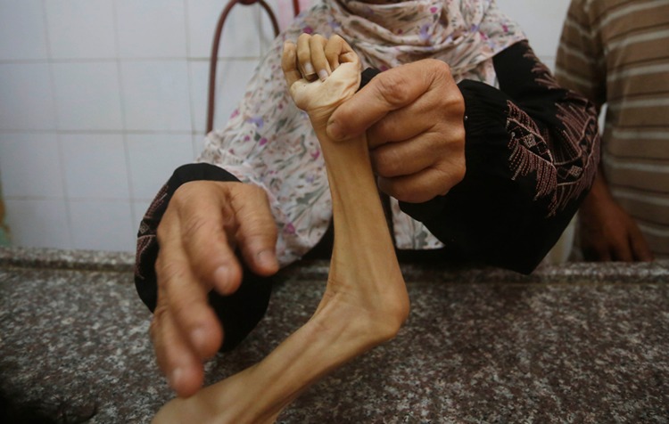 Can kaybının 59 bini aştığı Gazze’de son 24 saatte 19 kişi açlıktan hayatını kaybetti
